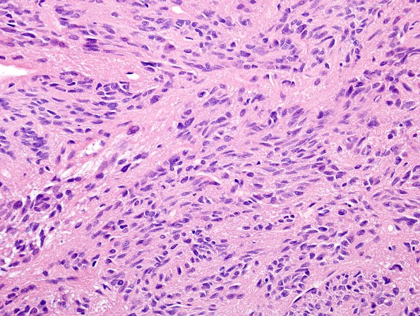 3A2 Spindle cell oncocytoma (Case 3) H&E 1