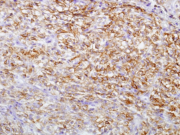 3C2 Spindle cell oncocytoma (Case 3) EMA 4