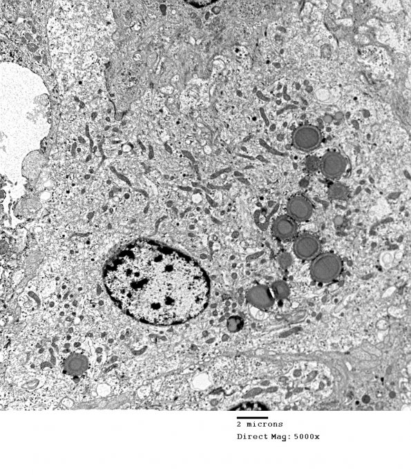 4E10 spindle Cell Oncocytoma (Case 4) EM 036 - Copy - Copy