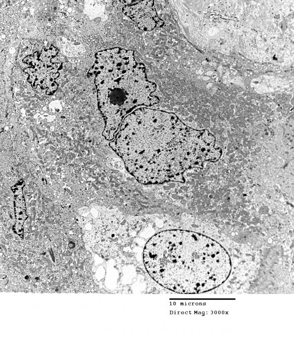 4E7 Spindle Cell Oncocytoma (Case 4) EM 033 - Copy