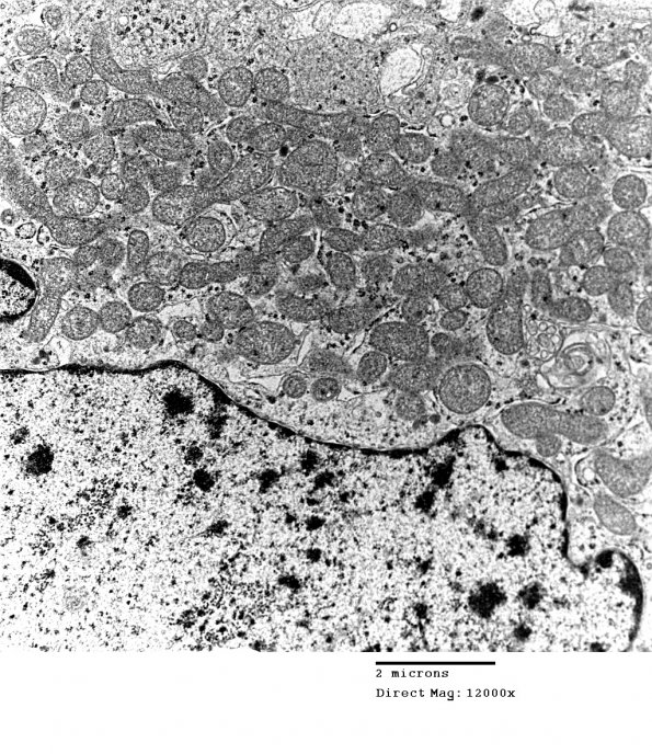 4E9 Spindle Cell Oncocytoma (Case 4) EM 035 - Copy