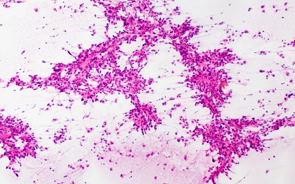 5A1 Spindle cell oncocytoma-pituicytoma DDX (Case 5) H&E 2 smear