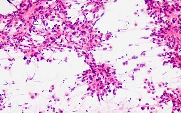 5A2 Spindle cell oncocytoma-pituicytoma DDX (Case 5) H&E 1 smear