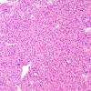 5A3 Spindle cell oncocytoma-pituicytoma DDX (Case 5) H&E 8