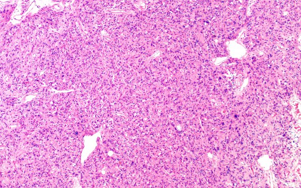 5A3 Spindle cell oncocytoma-pituicytoma DDX (Case 5) H&E 8