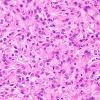 5A4 Spindle cell oncocytoma-pituicytoma DDX (Case 5) H&E 6