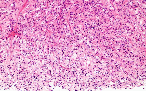 5A5 Spindle cell oncocytoma-pituicytoma DDX (Case 5) H&E 2