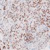 5B1 Spindle cell oncocytoma-pituicytoma DDX (Case 5) TTF1 3