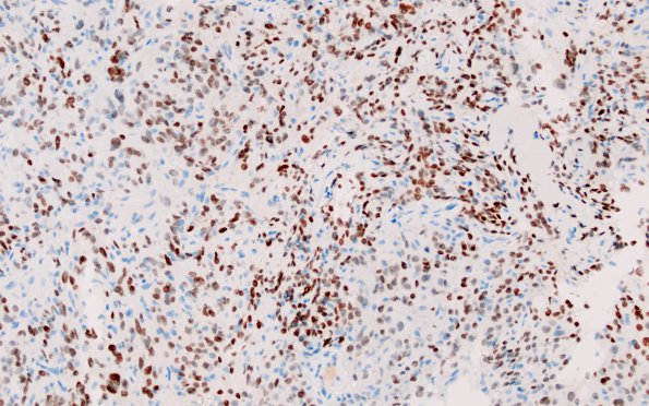 5B1 Spindle cell oncocytoma-pituicytoma DDX (Case 5) TTF1 3