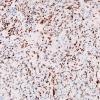 5B2 Spindle cell oncocytoma-pituicytoma DDX (Case 5) TTF1 1