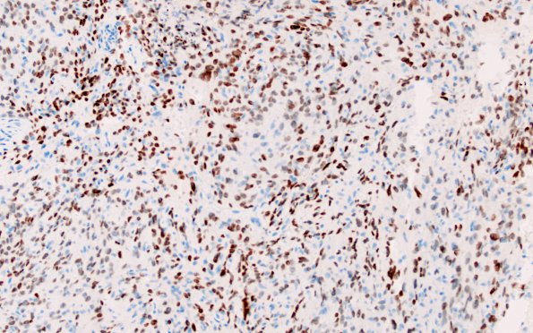 5B2 Spindle cell oncocytoma-pituicytoma DDX (Case 5) TTF1 1