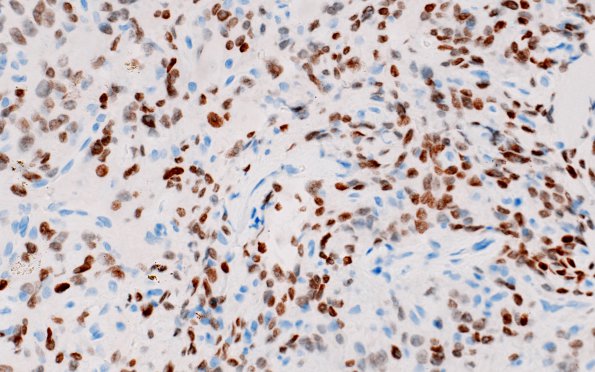 5B3 Spindle cell oncocytoma-pituicytoma DDX (Case 5) TTF1 2