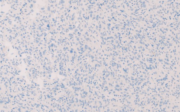 5C Spindle cell oncocytoma-pituicytoma DDX (Case 5) GFAP 1