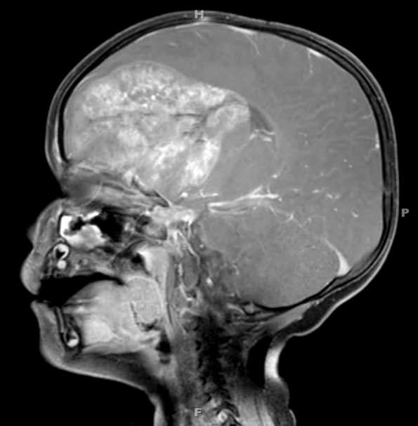 11A1 ATRT (Case 11) T1W MRI 1 - Copy