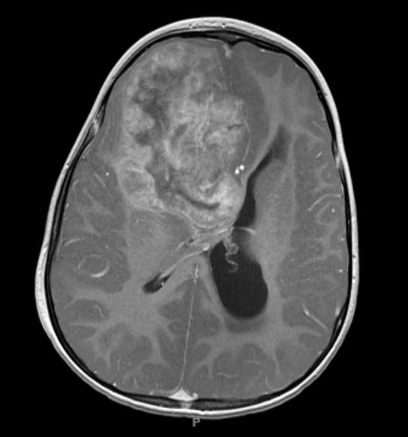 11A2 ATRT (Case 11) T1W MRI 2 - Copy