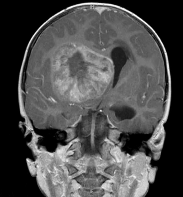 11A3 ATRT (Case 11) T1W MRI 3 - Copy