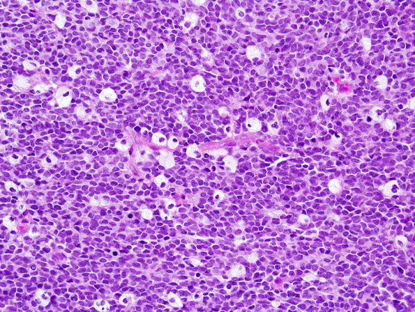 11B1 ATRT (Case 11) H&E 7.jpg