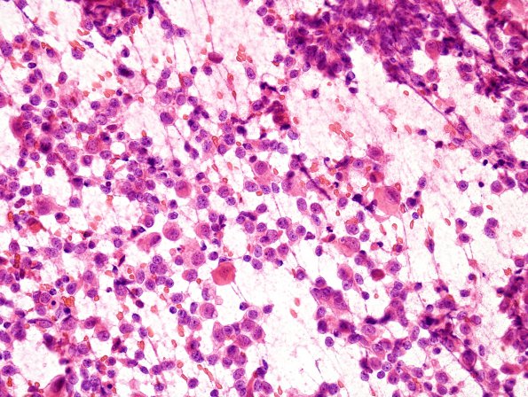 13B1 ATRT (Case 13) Smear 2