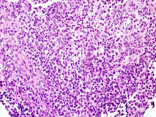 16B2 ATRT. spinal & tectal (Case 16) H&E 5.jpg