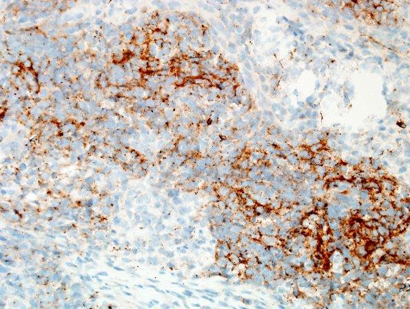 16C2 ATRT. spinal & tectal (Case 16) SYN 4.jpg