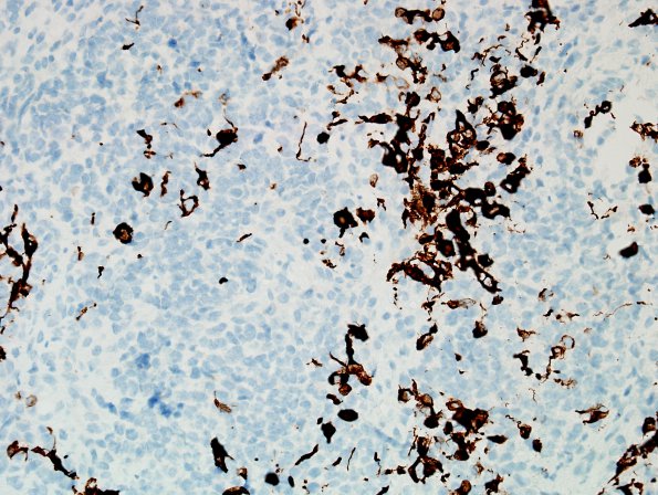 16C3 ATRT. spinal & tectal (Case 16) GFAP 1.jpg