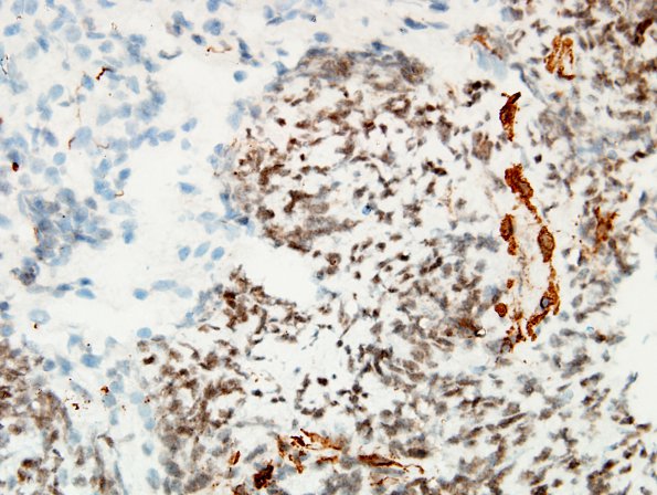 16D1 ATRT. spinal & tectal (Case 16) SMA.jpg