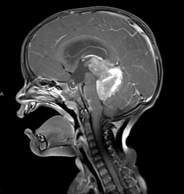 17A2 ATRT (Case 17) T1 W 1 - Copy