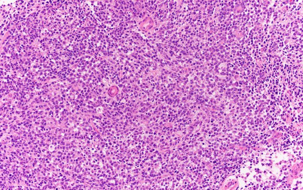 17B2 ATRT (Case 17) H&E 20X 2