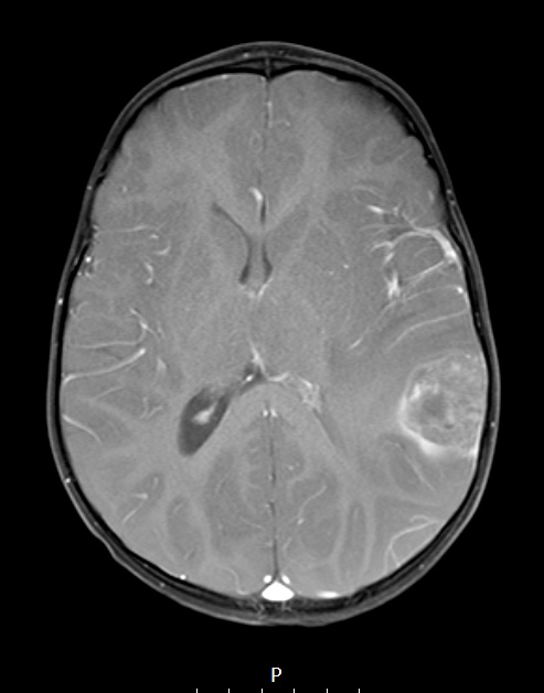 19A1 ATRT (Case 19) T1W - Copy