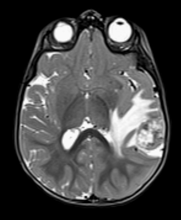 19A2 ATRT (Case 19) T2W - Copy