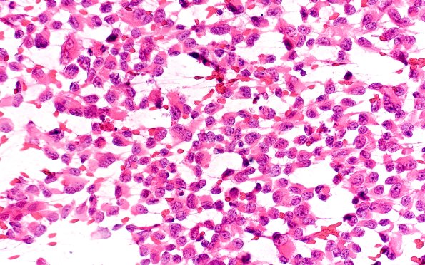 19B1 ATRT (Case 19) H&E Smear 40X 4