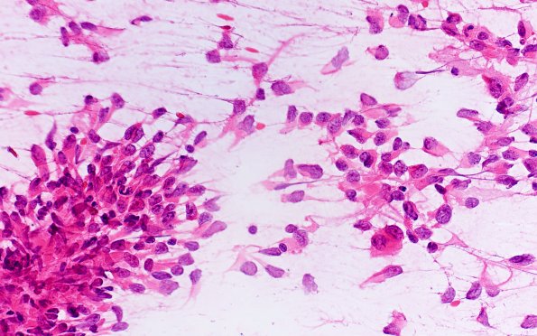 19B2 ATRT (Case19) H&E Smear 40X 2