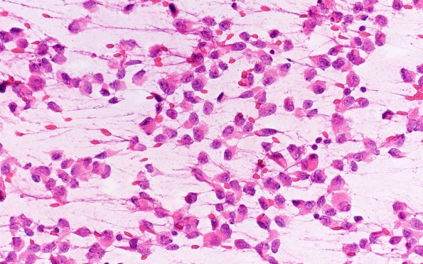 19B3 ATRT (Case 19) H&E Smear 40X 1