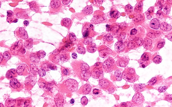 19B4 ATRT (Case 19) H&E Smear 100X 4