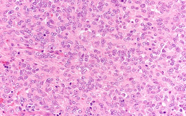 19C3 ATRT (Case 19) H&E 40X 2