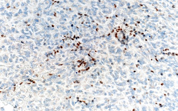 19J4 ATRT (Case 19) INI1 40X 3