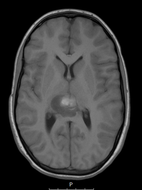 1A1 ATRT (Case 1) T1 no C - Copy