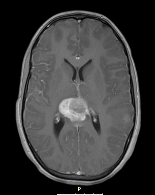 1A2 ATRT (Case 1) T1 W - Copy