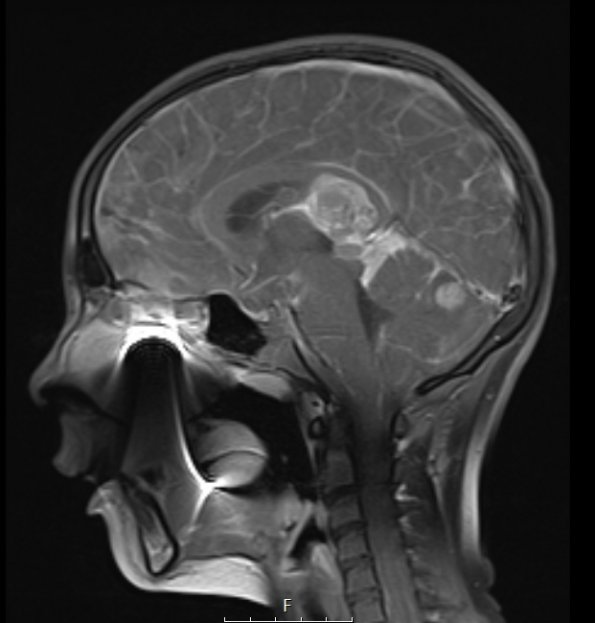 1A3 ATRT (Case 1) T1 W sag - Copy