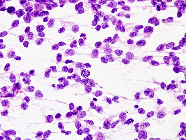  1B1 ATRT (Case 1) H&E smear 3.jpg