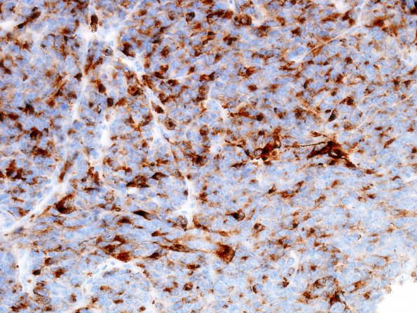 1F4 ATRT (Case 1) EMA 1.jpg