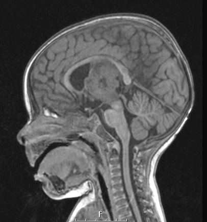 20A2 ATRT (NP24-888) T1 noC sag - Copy