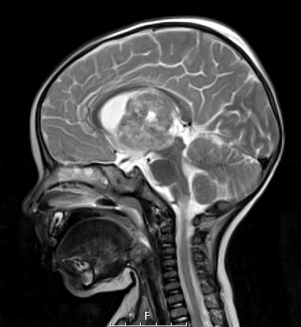 20A3 ATRT (NP24-888) T2W sag 2 - Copy