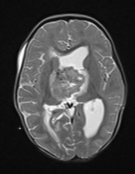 20A4 ATRT (NP24-888) T2W axial - Copy