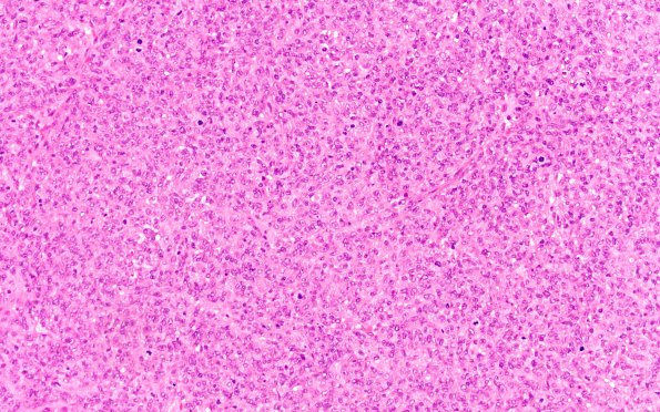 20B1 ATRT (NP24-888) H&E 20X