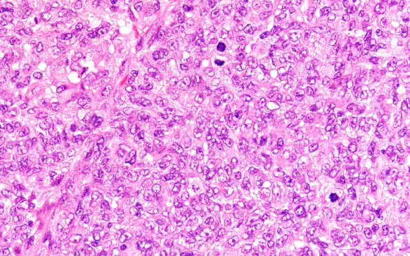 20B2 ATRT (NP24-888) H&E 40X 1