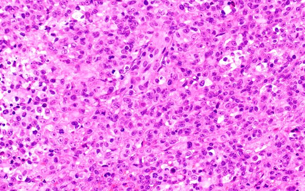 20B4 ATRT (NP24-888) A2 H&E 40X 1