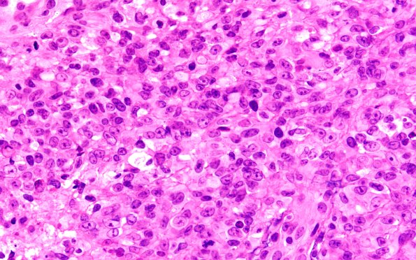 20B6 ATRT (NP24-888) A2 H&E 60X 1