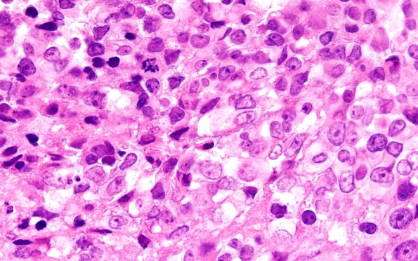 20B7 ATRT (NP24-888) A2 H&E 100X 1