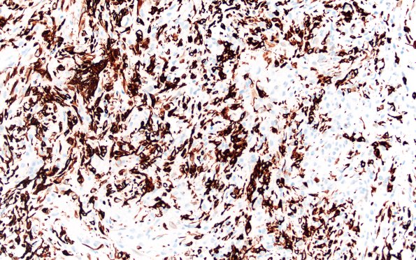 20C ATRT (NP24-888) A2 GFAP 20X 2